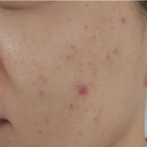 Hydrodermabrasion-after-treatment.jpg