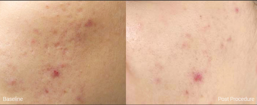 Aquapure hydrodermabrasion, Before After.jpg
